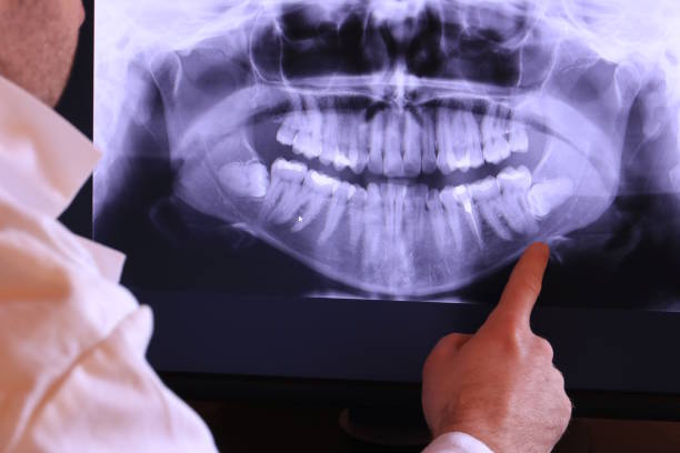 Best Emergency Tooth Extraction in Olney, TX